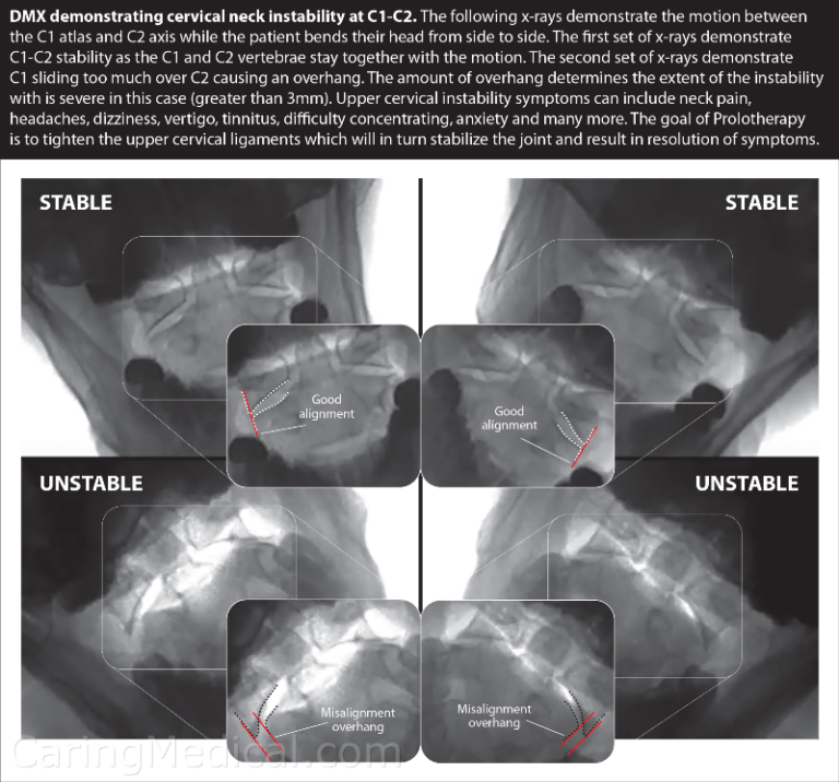 My diagnostic hypothesis – cervical instability, sympathetic nervous